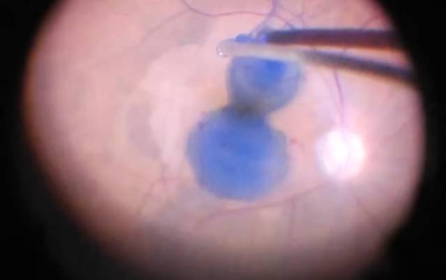 首例ILM-BLUE術中應用照片：染色效果良好，囊膜邊界清晰。